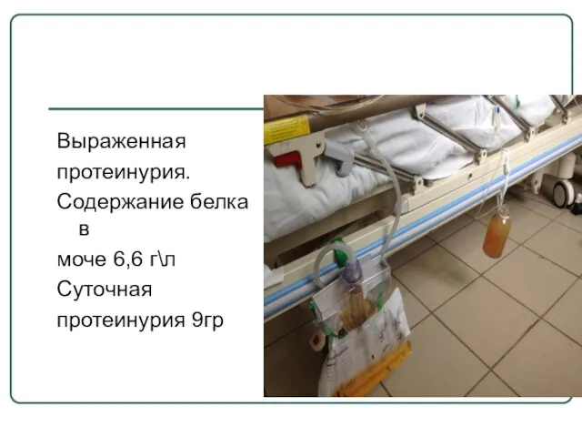 Выраженная протеинурия. Содержание белка в моче 6,6 г\л Суточная протеинурия 9гр