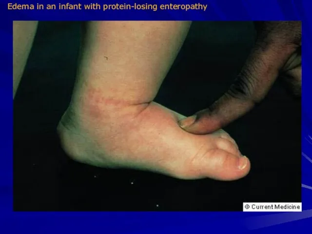 Edema in an infant with protein-losing enteropathy
