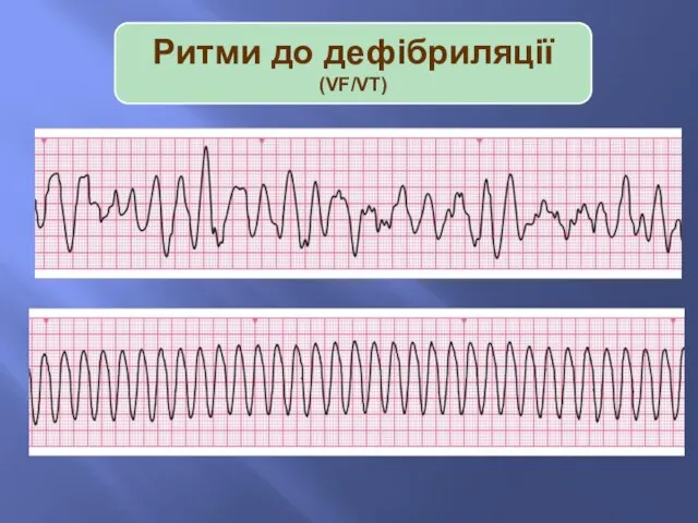 Ритми до дефібриляції (VF/VT)‏