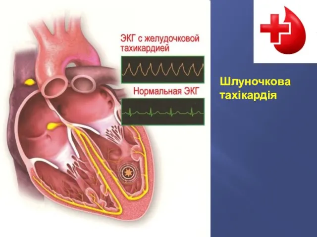 Шлуночкова тахікардія