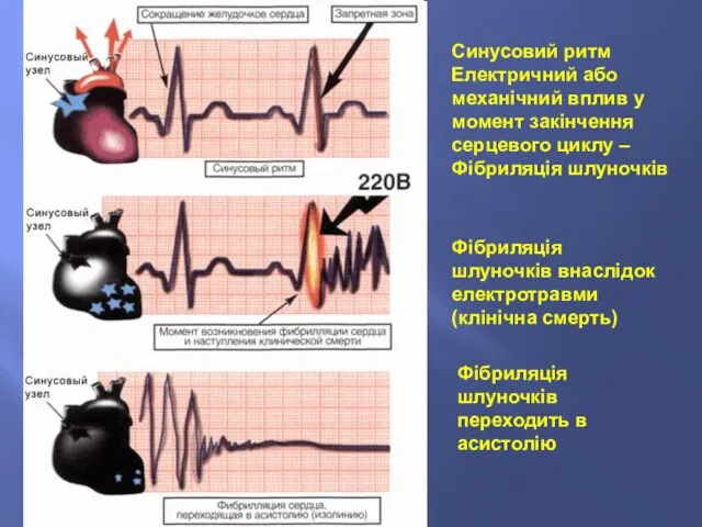 Фібриляція шлуночків внаслідок електротравми (клінічна смерть) Фібриляція шлуночків переходить в асистолію