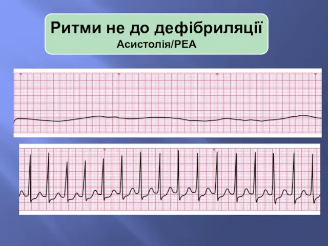 Ритми не до дефібриляції Асистолія/PEA