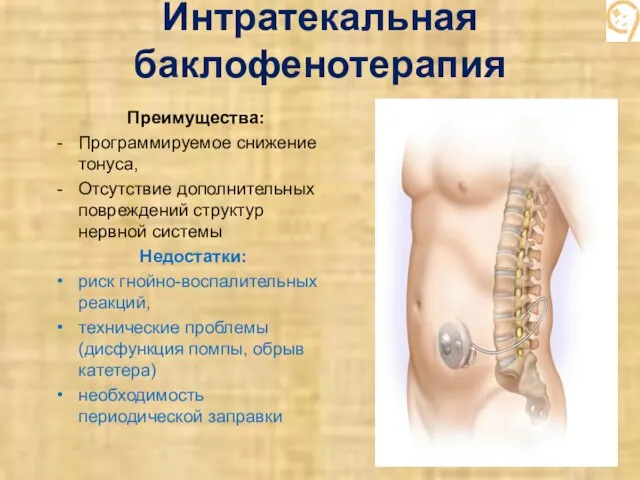 Интратекальная баклофенотерапия Преимущества: Программируемое снижение тонуса, Отсутствие дополнительных повреждений структур нервной