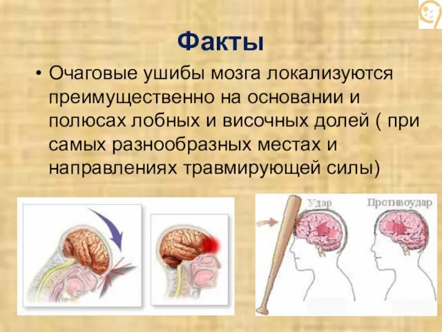 Факты Очаговые ушибы мозга локализуются преимущественно на основании и полюсах лобных