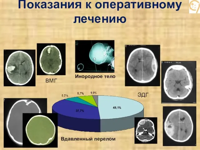 Показания к оперативному лечению ЭДГ Вдавленный перелом ВМГ Инородное тело