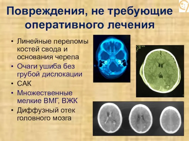 Повреждения, не требующие оперативного лечения Линейные переломы костей свода и основания