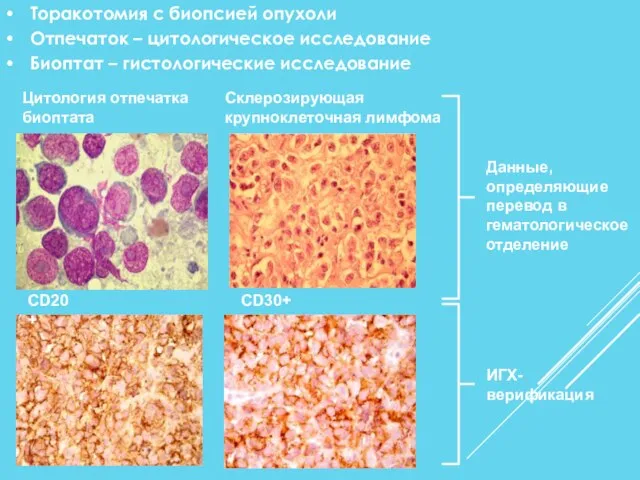 Склерозирующая крупноклеточная лимфома CD20+ Цитология отпечатка биоптата CD30+ Торакотомия с биопсией