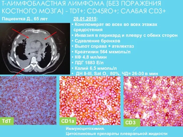 Т-ЛИМФОБЛАСТНАЯ ЛИМФОМА (БЕЗ ПОРАЖЕНИЯ КОСТНОГО МОЗГА) - TDT+; CD45RO+; СЛАБАЯ CD3+