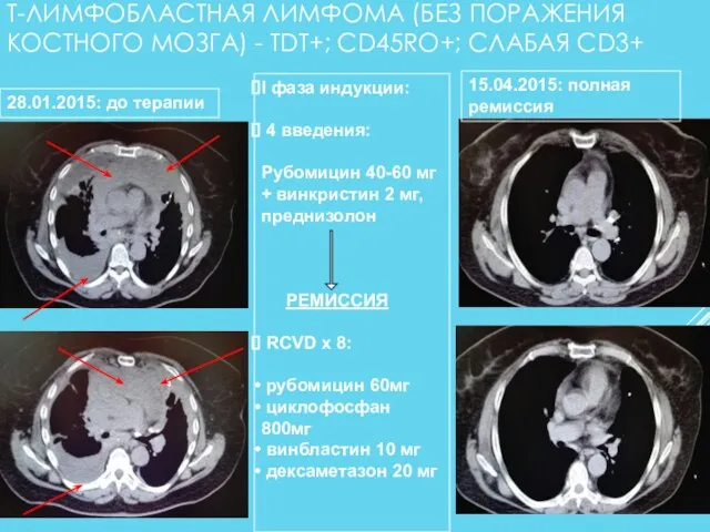 Т-ЛИМФОБЛАСТНАЯ ЛИМФОМА (БЕЗ ПОРАЖЕНИЯ КОСТНОГО МОЗГА) - TDT+; CD45RO+; СЛАБАЯ CD3+