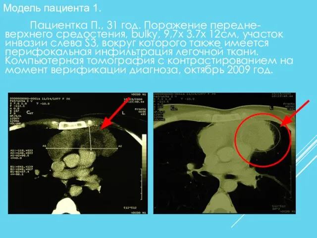 Пациентка П., 31 год. Поражение передне-верхнего средостения, bulky, 9,7х 3.7х 12см,