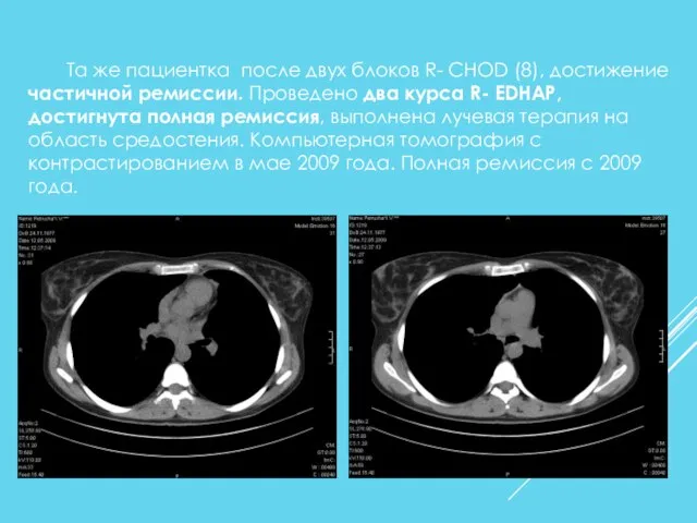 Та же пациентка после двух блоков R- CHOD (8), достижение частичной