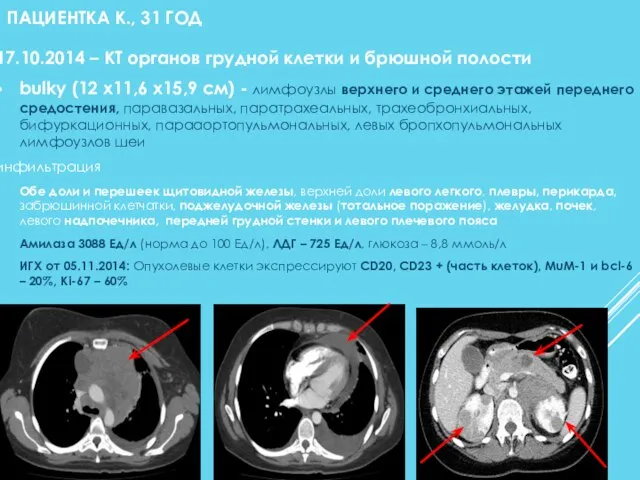 ПАЦИЕНТКА К., 31 ГОД 17.10.2014 – КТ органов грудной клетки и