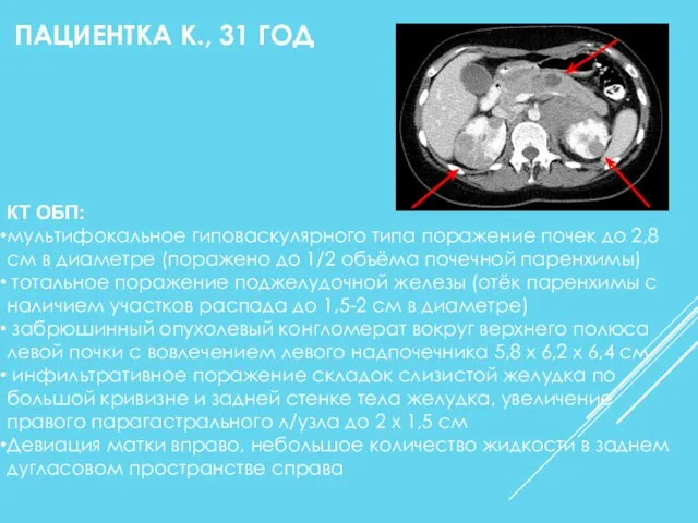 КТ ОБП: мультифокальное гиповаскулярного типа поражение почек до 2,8 см в