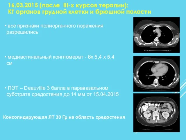 16.03.2015 (после III-х курсов терапии): КТ органов грудной клетки и брюшной