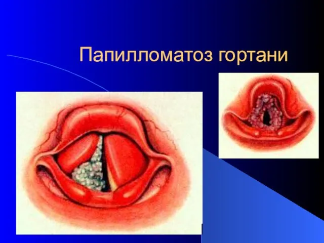 Папилломатоз гортани