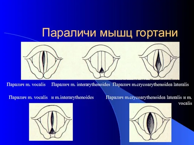 Параличи мышц гортани Паралич m. vocalis Паралич m. interarythenoides Паралич m.crycoarythenoidea