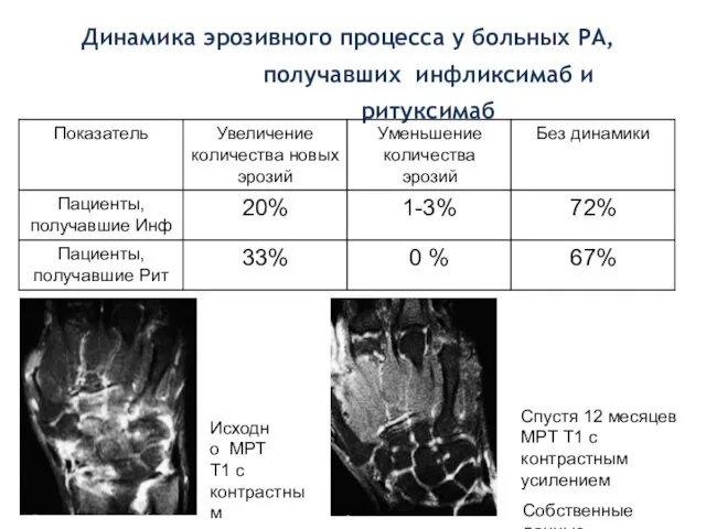 Динамика эрозивного процесса у больных РА, получавших инфликсимаб и ритуксимаб Исходно