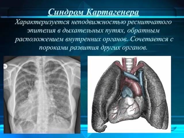 Синдром Картагенера Характеризуется неподвижностью реснитчатого эпителия в дыхательных путях, обратным расположением