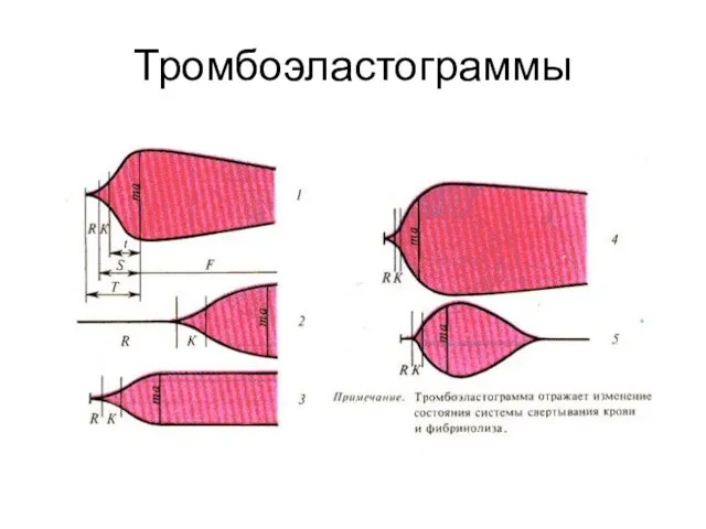 Тромбоэластограммы