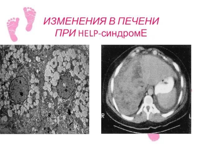 ИЗМЕНЕНИЯ В ПЕЧЕНИ ПРИ HELP-синдромЕ