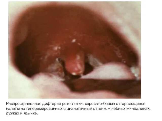 Распространенная дифтерия ротоглотки: серовато-белые отторгающиеся налеты на гиперемированных с цианотичным оттенком небных миндалинах, дужках и язычке.