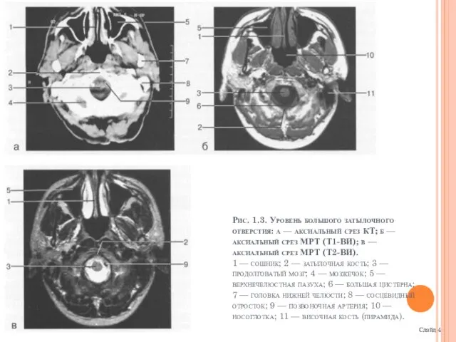 Слайд 4 Рис. 1.3. Уровень большого затылочного отвер­стия: а — аксиальный