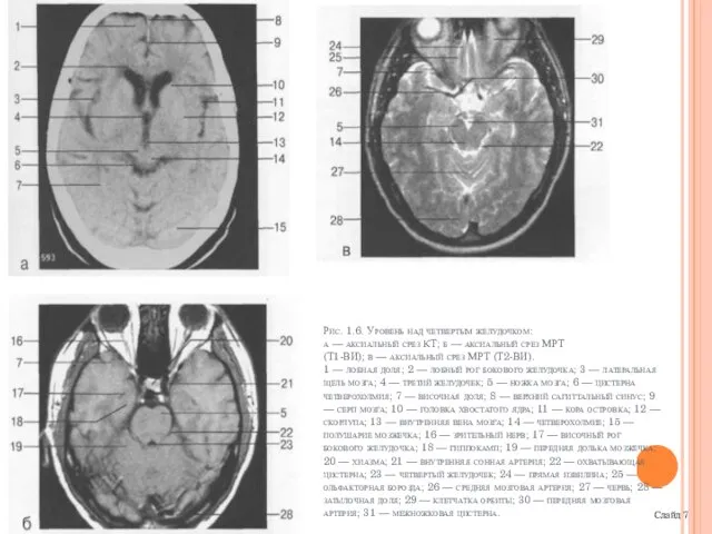 Слайд 7 Рис. 1.6. Уровень над четвертым желудочком: а — аксиальный