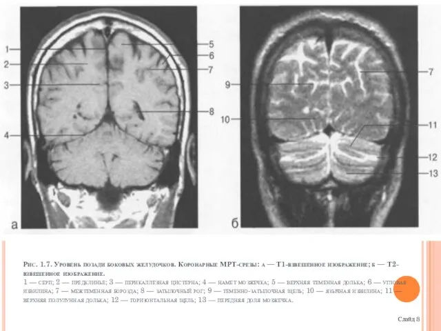 Рис. 1.7. Уровень позади боковых желудочков. Коронарные МРТ-срезы: а — Т1-взвешенное