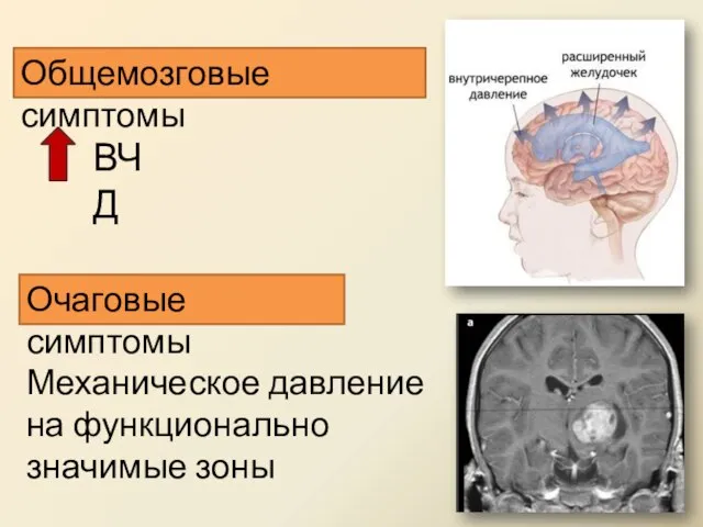 Общемозговые симптомы Очаговые симптомы ВЧД Механическое давление на функционально значимые зоны