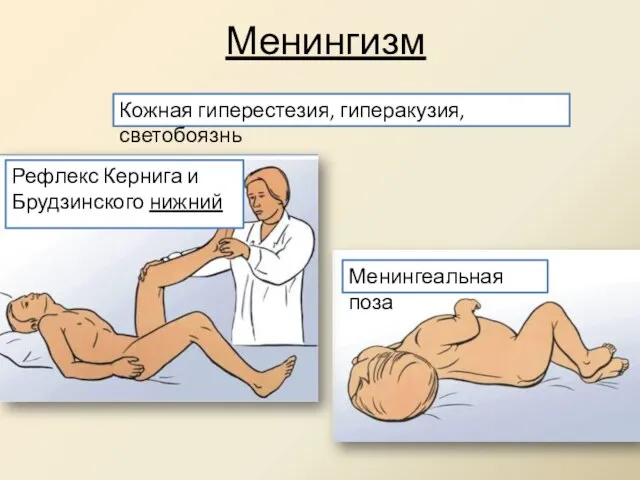 Менингизм Кожная гиперестезия, гиперакузия, светобоязнь