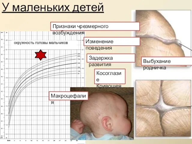 Изменение поведения Задержка развития Признаки чрезмерного возбуждения Косоглазие Кривошея Макроцефалия Выбухание родничка У маленьких детей