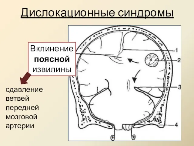 Дислокационные синдромы Вклинение поясной извилины сдавление ветвей передней мозговой артерии