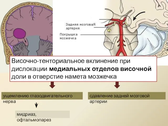 ущемлению глазодвигательного нерва сдавление задней мозговой артерии мидриаз, офтальмопарез Височно-тенториальное вклинение