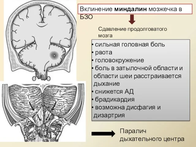 Вклинение миндалин мозжечка в БЗО Сдавление продолговатого мозга сильная головная боль