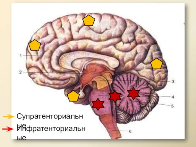 Супратенториальные Инфратенториальные