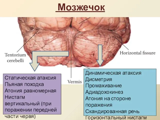 Мозжечок Статическая атаксия Пьяная походка Атония равномерная Нистагм вертикальный (при поражении