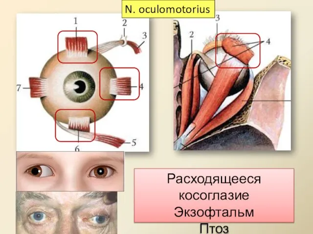 Расходящееся косоглазие Экзофтальм Птоз N. oculomotorius