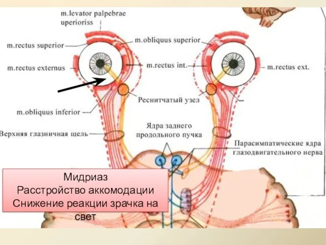 Мидриаз Расстройство аккомодации Снижение реакции зрачка на свет