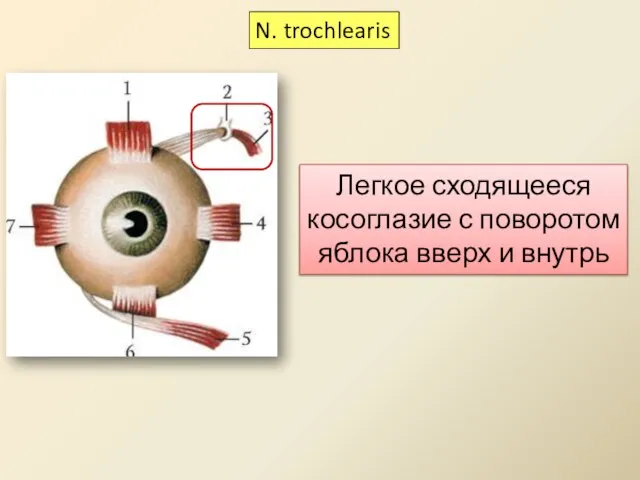 Легкое сходящееся косоглазие с поворотом яблока вверх и внутрь N. trochlearis