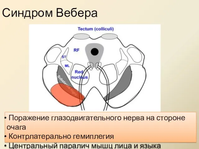 Синдром Вебера Поражение глазодвигательного нерва на стороне очага Контрлатерально гемиплегия Центральный паралич мышц лица и языка