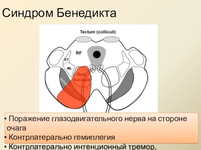 Синдром Бенедикта Поражение глазодвигательного нерва на стороне очага Контрлатерально гемиплегия Контрлатерально интенционный тремор, хореоатетоз