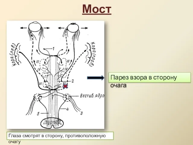 Мост Парез взора в сторону очага Глаза смотрят в сторону, противоположную очагу