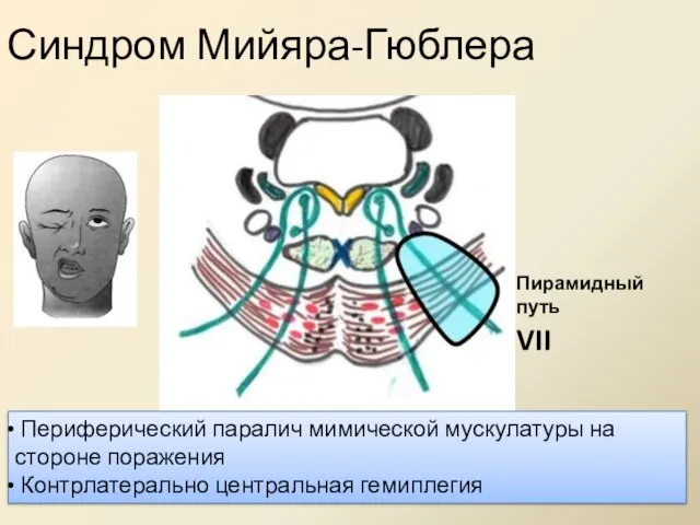 Синдром Мийяра-Гюблера Периферический паралич мимической мускулатуры на стороне поражения Контрлатерально центральная гемиплегия VII Пирамидный путь