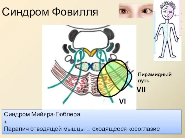 Синдром Фовилля Синдром Мийяра-Гюблера + Паралич отводящей мышцы ? сходящееся косоглазие VI VII Пирамидный путь