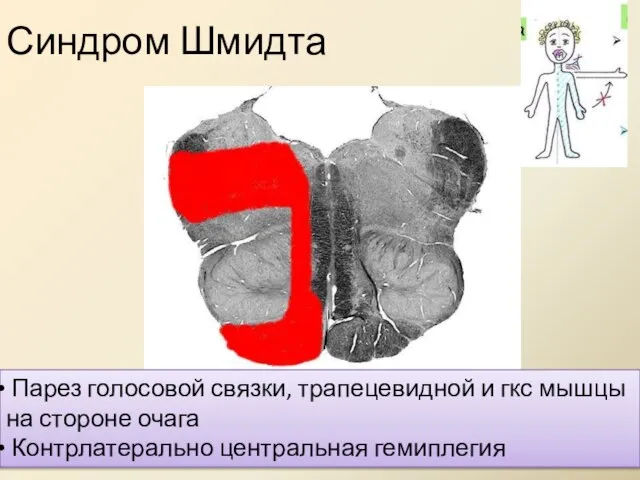 Синдром Шмидта Парез голосовой связки, трапецевидной и гкс мышцы на стороне очага Контрлатерально центральная гемиплегия