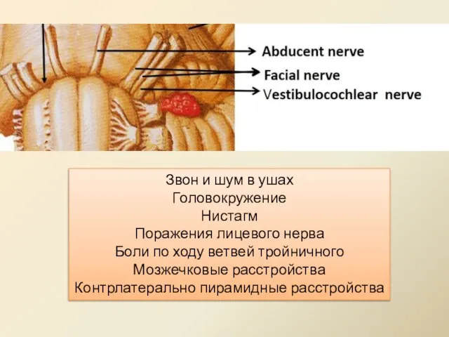 Звон и шум в ушах Головокружение Нистагм Поражения лицевого нерва Боли