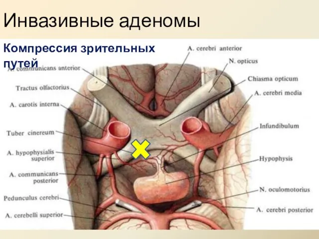 Инвазивные аденомы Компрессия зрительных путей