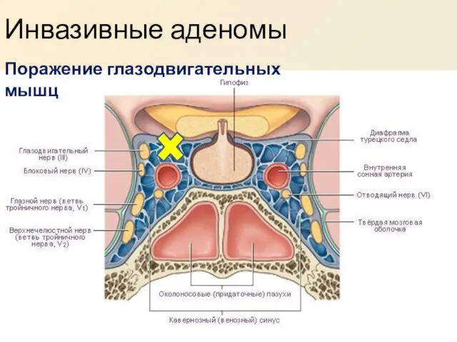 Инвазивные аденомы Поражение глазодвигательных мышц