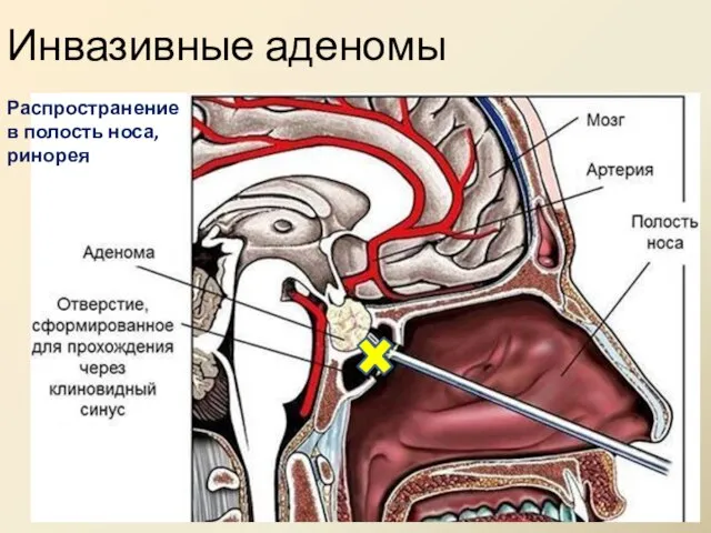 Инвазивные аденомы Распространение в полость носа, ринорея