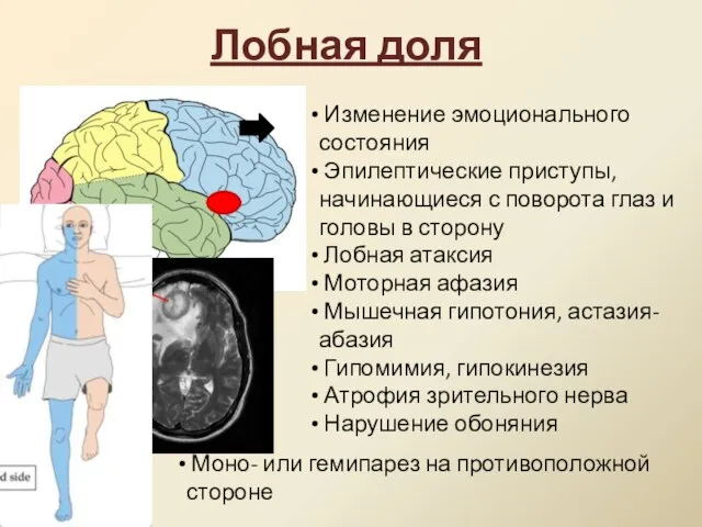 Лобная доля Изменение эмоционального состояния Эпилептические приступы, начинающиеся с поворота глаз